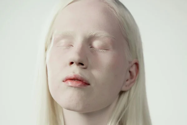 Se constituye la Unión Latinoamericana de Albinos con presidencia en República Dominicana